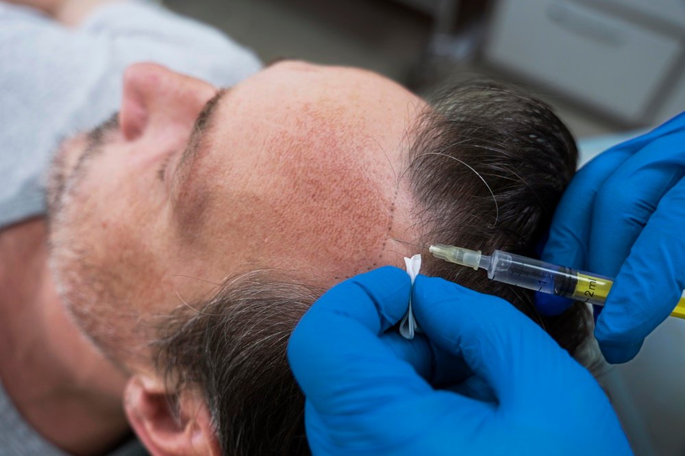 stem cell for hair growth